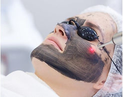 peeling-de-carbon-activado-con-laser-hollywood-peel.jpg